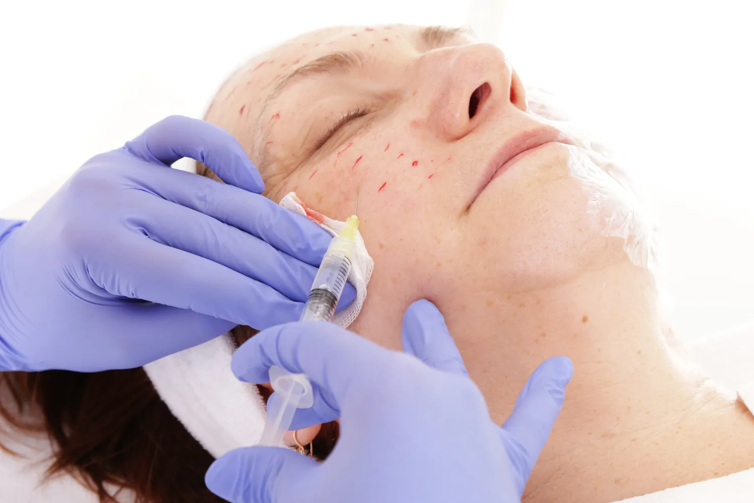 Jak zlikwidować zmarszczki pod oczami medycyna estetyczna?