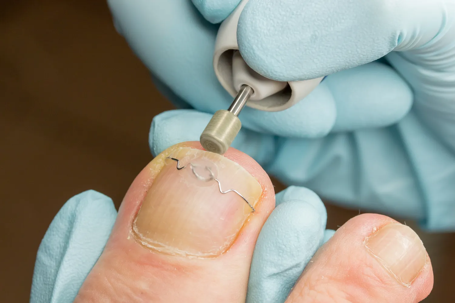  Powstawanie, usuwanie i leczenie modzeli